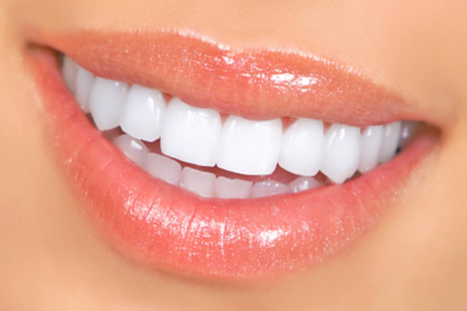 carillas dentales odontokids malaga 1