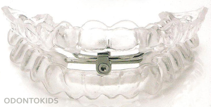 Odontokids - clinica dental Malaga - ortodoncia - infantil